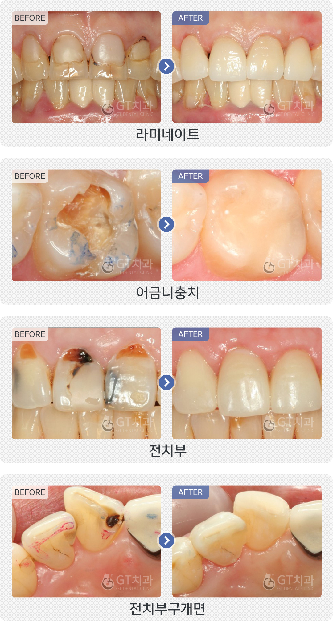 충치치료사례