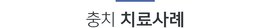 충치치료사례