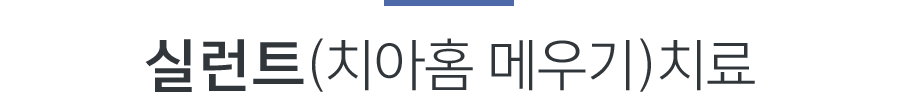 실런트(치아홈 메우기)치료