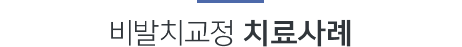 비발치교정 치료사례